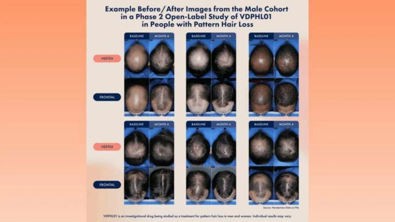 새로 나왓다는 머리카락 발모제.jpg | 인스티즈