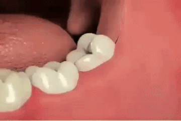 매복 사랑니 뽑으세요 체질이란게 바뀝니다.gif | 인스티즈