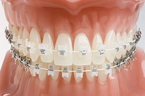 교정하러 처음 치과에 갔을 때 교정기 종류가 생각보다 많아서 놀랐음 | 인스티즈