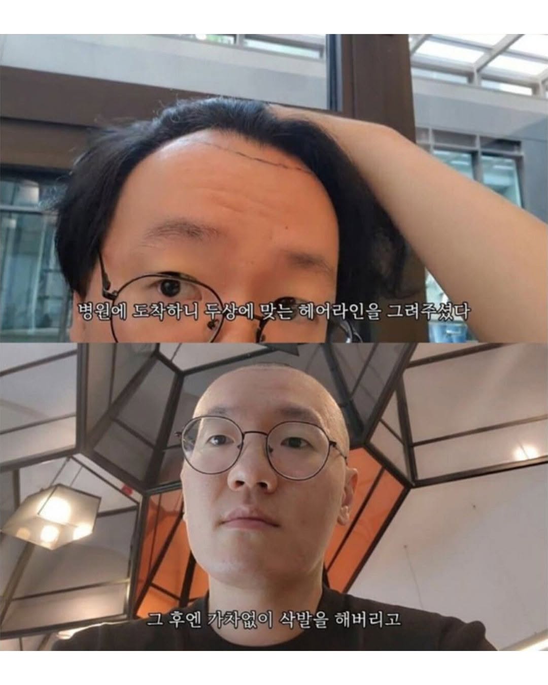 터키로 모발이식 받으러간 남성..jpg | 인스티즈