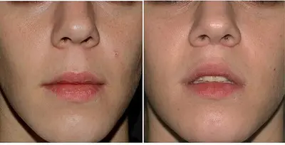 [정보/소식] 인중 축소 수술후 부작용 쎄게온 이지혜 최근 | 인스티즈