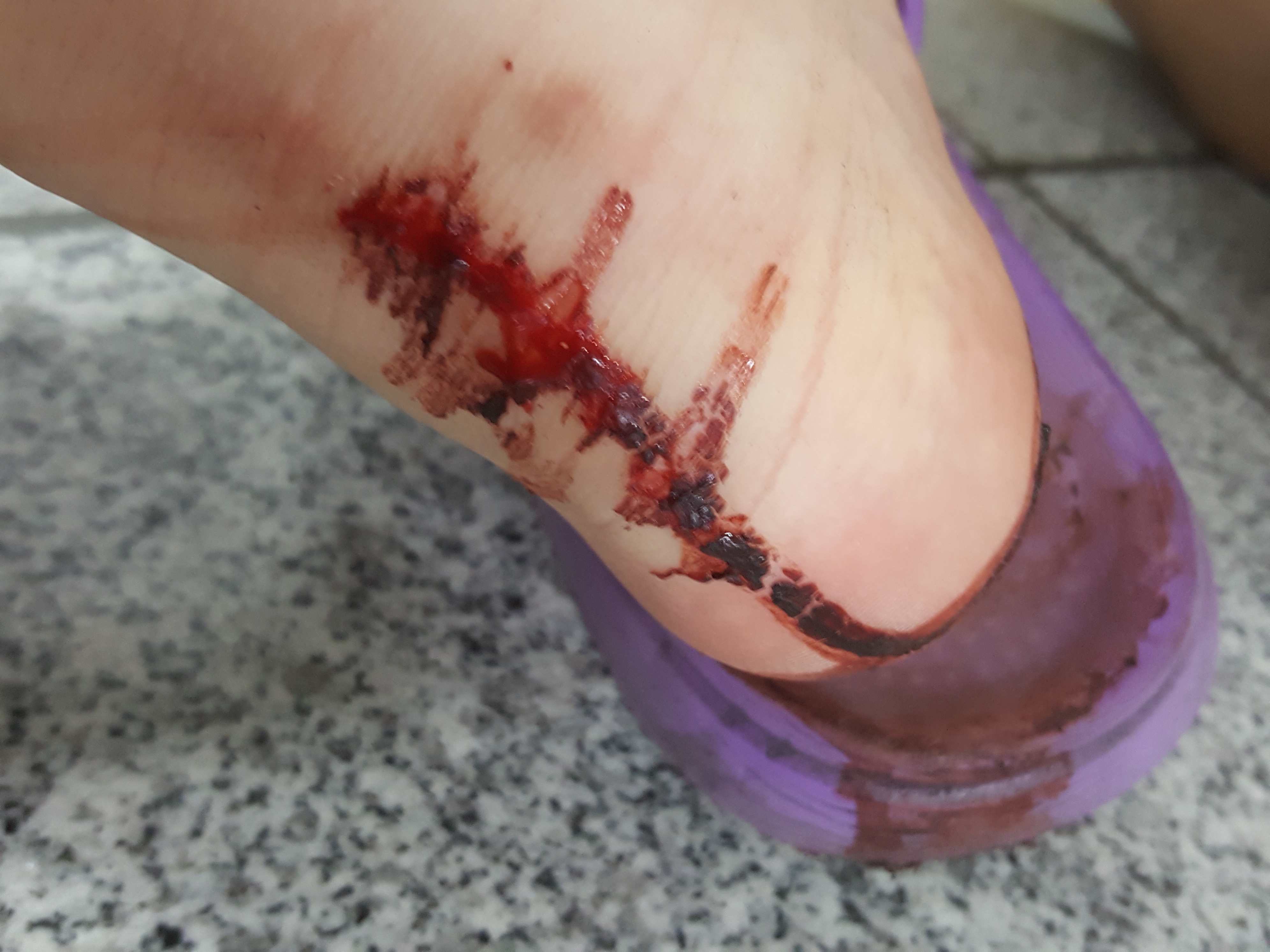 나는 발뒤꿈치에서 피가 이렇게까지 날 수도 있구나~라는 걸 오늘 알았어(ㅎㅇㅈㅇ) | 인스티즈