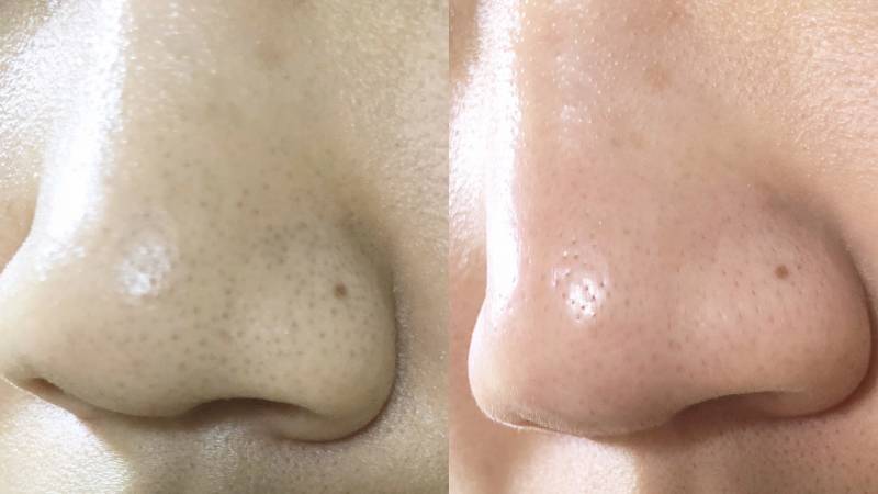 10년째 블랙헤드와 싸우는 쓰니의 블랙헤드 제거(?)전후(40) | 인스티즈