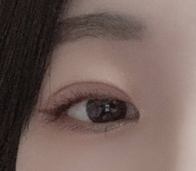 서울 유명한 병원에서 쌍수한 후기💝💝🙌 - 인스티즈(Instiz) 익명뷰티 카테고리