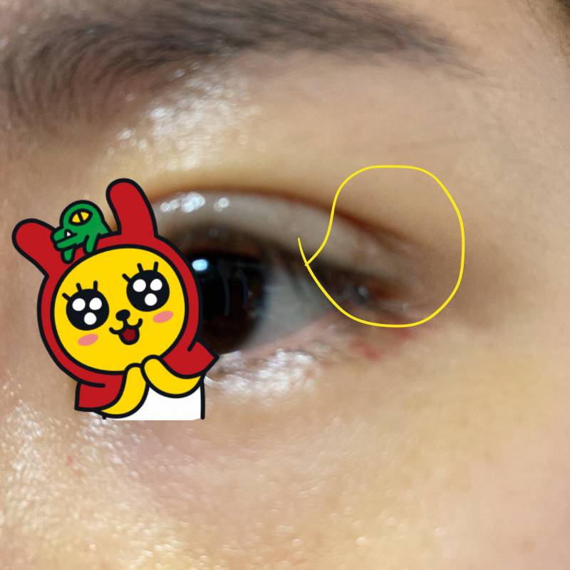 쌍수했는데 쌍꺼풀 끝에 라인이 두겹이야 - 인스티즈(Instiz) 익명뷰티 카테고리