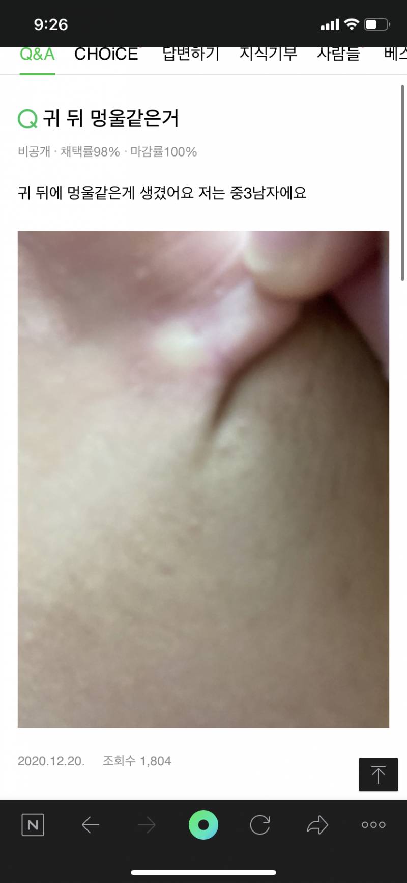 귀 뒤에 멍울지고 만지면 여드름처럼 아픈거 무ㅏ야??? ㅠㅠ 방치해도돼?? - 인스티즈(Instiz) 익명잡담 카테고리