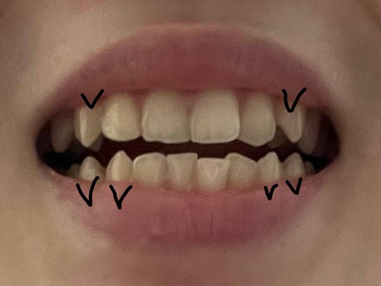 ㅎㅇㅈㅇ(치아사진) 송곳니? 갈면 괜찮아져? | 인스티즈