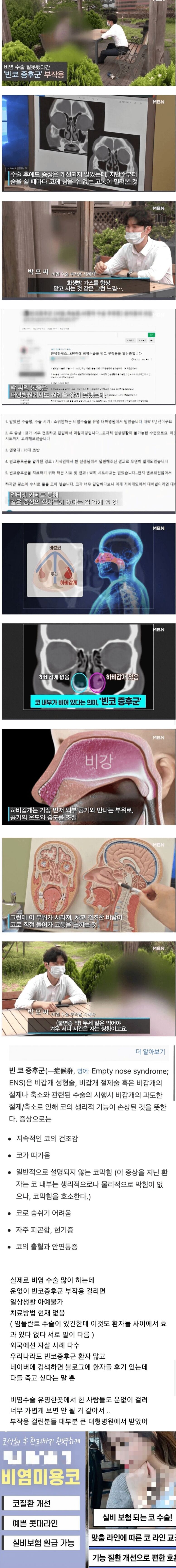 극단적 선택 사례까지 나온다는 비염수술 부작용.jpg | 인스티즈