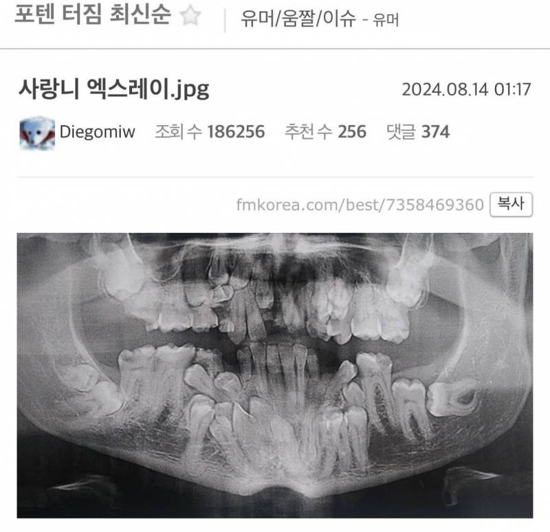 [잡담] 치아가 실제로 이렇게 자랄 수도 있는 거야? | 인스티즈