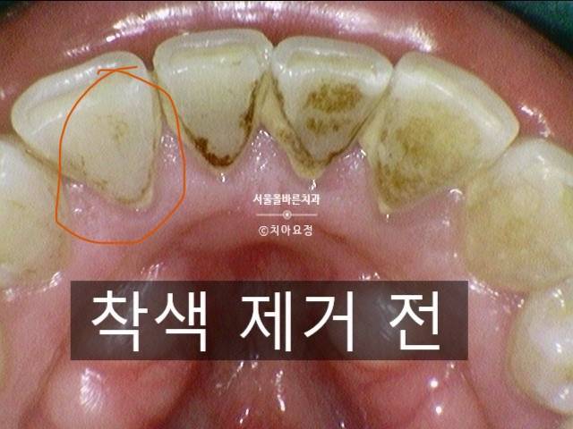 [잡담] 커피 먹으면 치석? 잘 생겨?? | 인스티즈