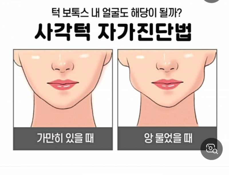 [잡담] 턱보톡스 맞은애들아 너네 자가진단하고 갓어? | 인스티즈