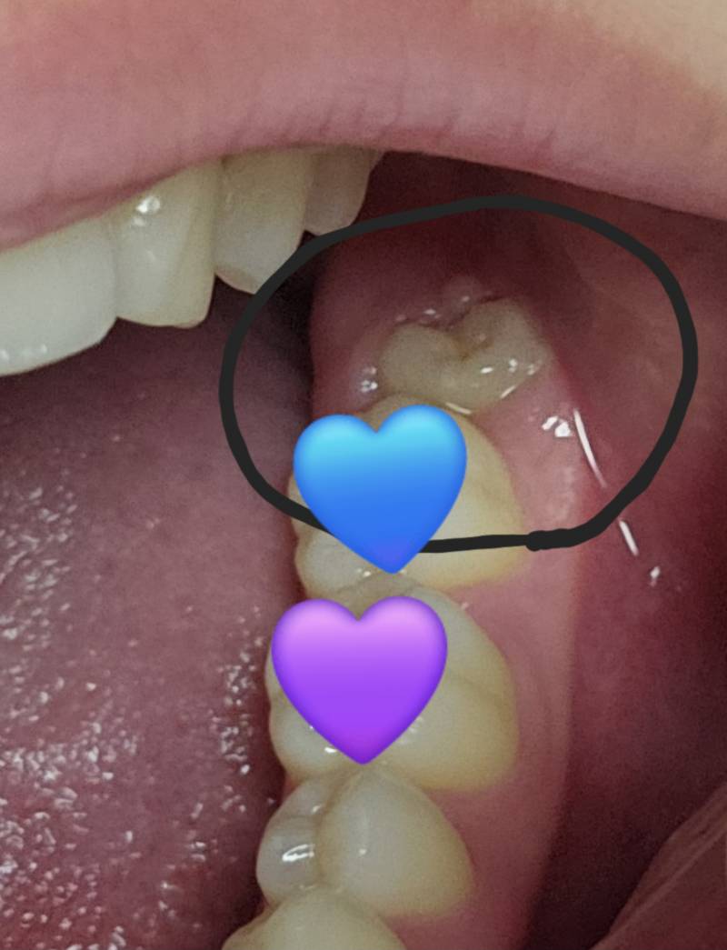 [잡담] 사랑니... 이거 빼야할까...? | 인스티즈