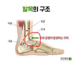 [잡담] 발목이 너무너무 아파 | 인스티즈