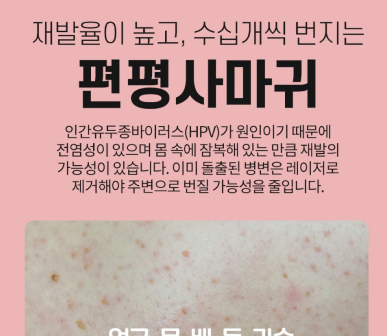 [잡담] 얼굴에 편평사마귀 생기는 이유가 hpv, 자궁경부암 때문이야????????? | 인스티즈