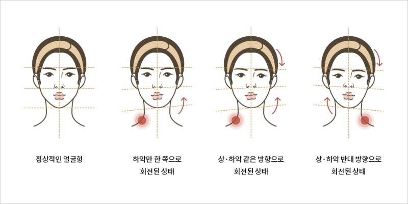 [잡담] 턱관절 아프면 얼굴 이렇게 틀어지는이유가 뭐야 | 인스티즈