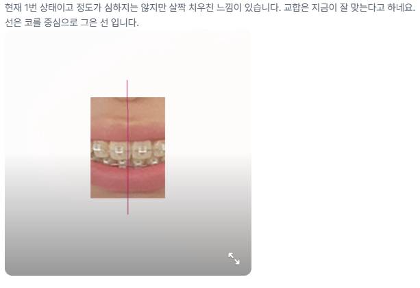 [잡담] 교정에 대해 잘 아는 사람 제발 의료지식 있는사람 제발 중심선 잘 보는사람 제발 | 인스티즈