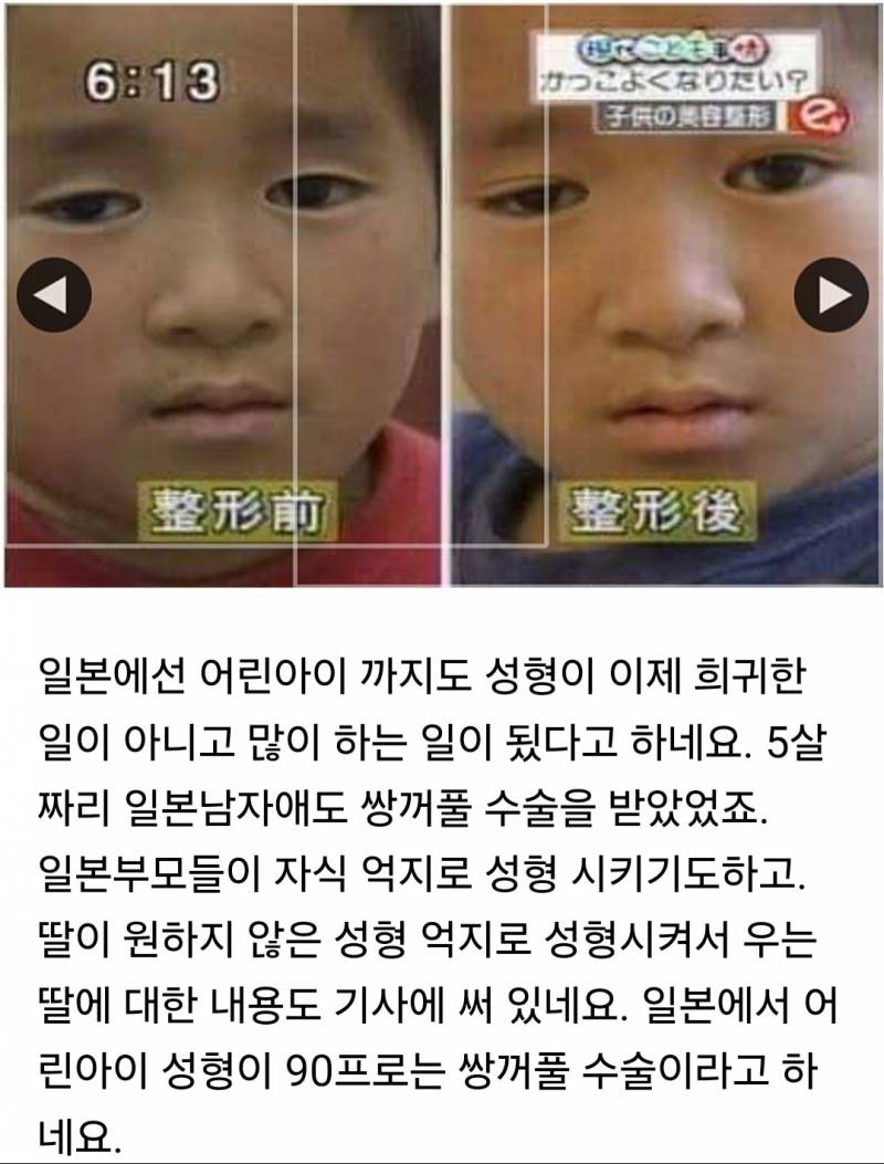 성형수술 받는 일본 어린이들.. | 인스티즈