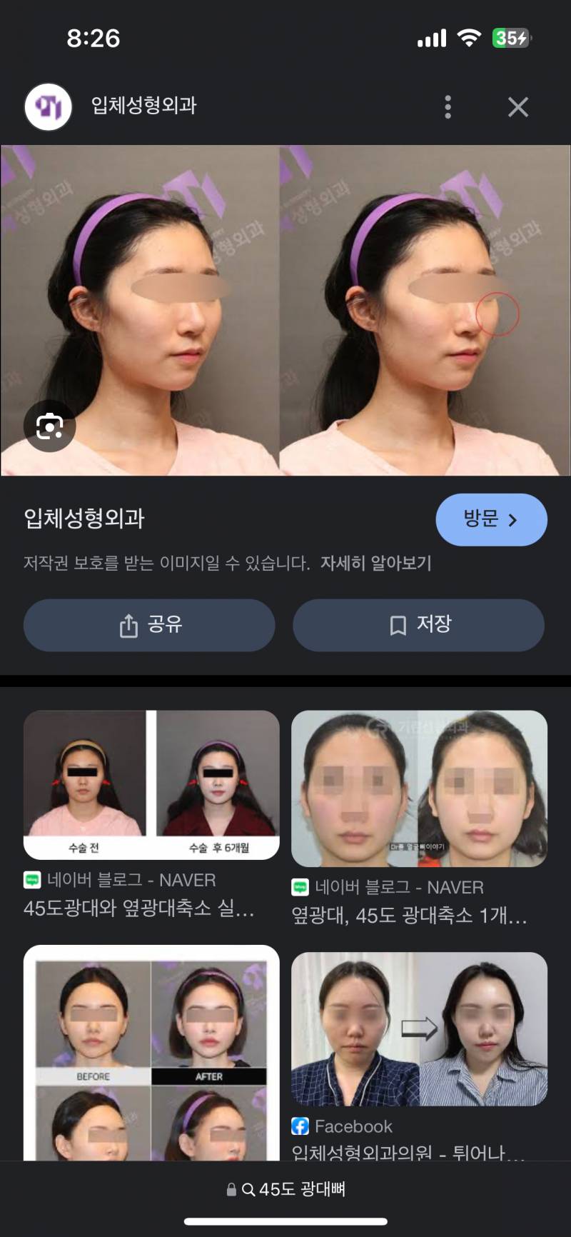 [잡담] 익들 광대가 이러면 성형할거임??? | 인스티즈