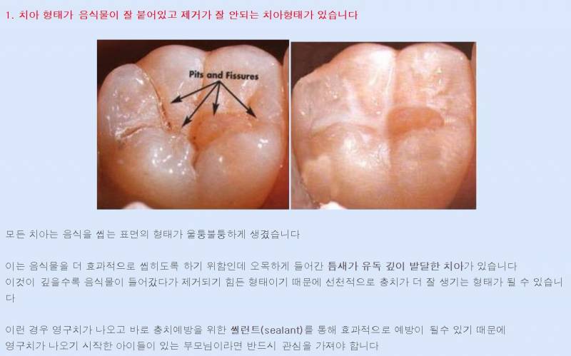 [잡담] 어이없지만 요아정 벌꿀집 먹고 나온 밀랍 뭉쳐서 어금니에 갖다가 대고 찍어봐 | 인스티즈