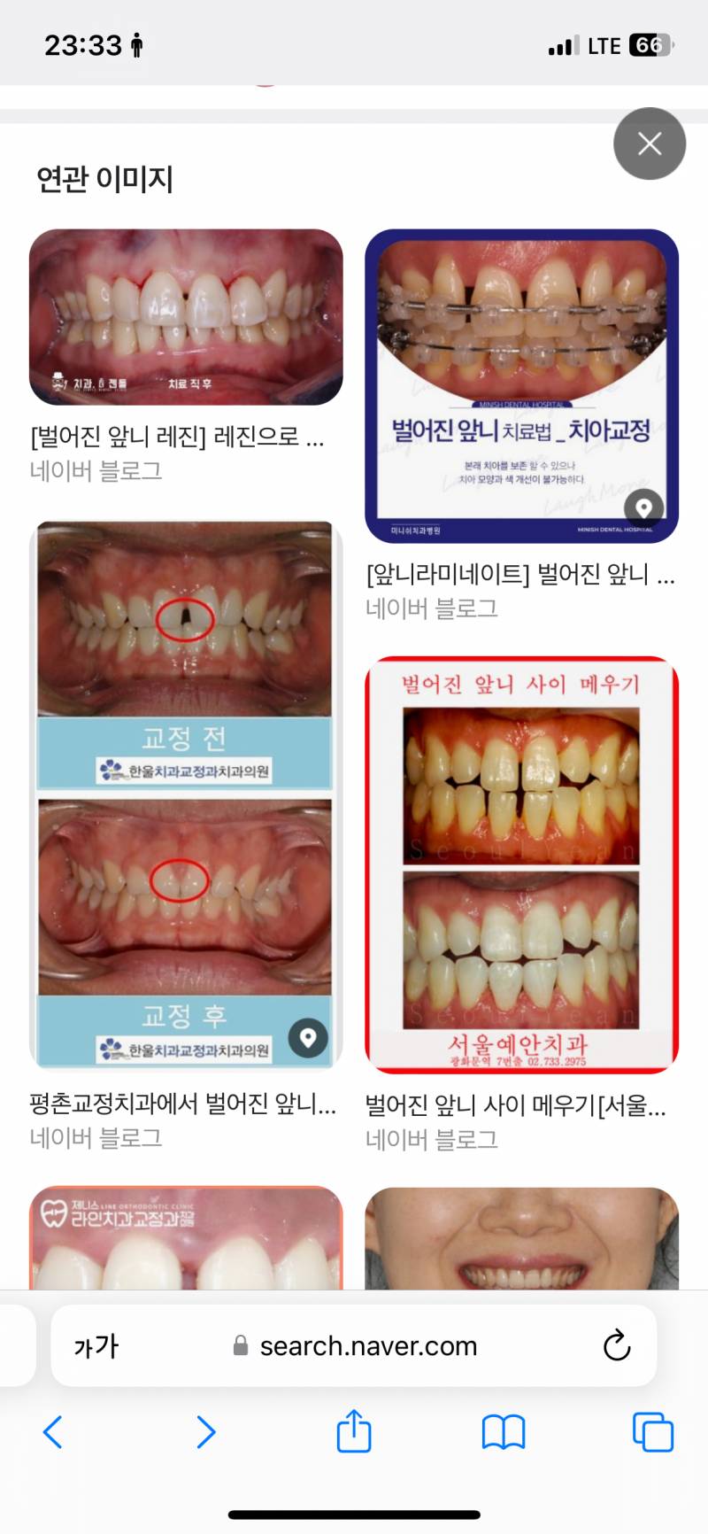 [잡담] 치아교정 어디서 할까..? | 인스티즈