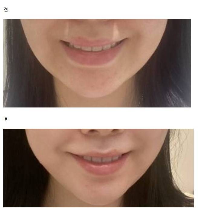 [잡담] 한의원 안면비대칭 교정 10회 vs 턱근육 마사지기 | 인스티즈