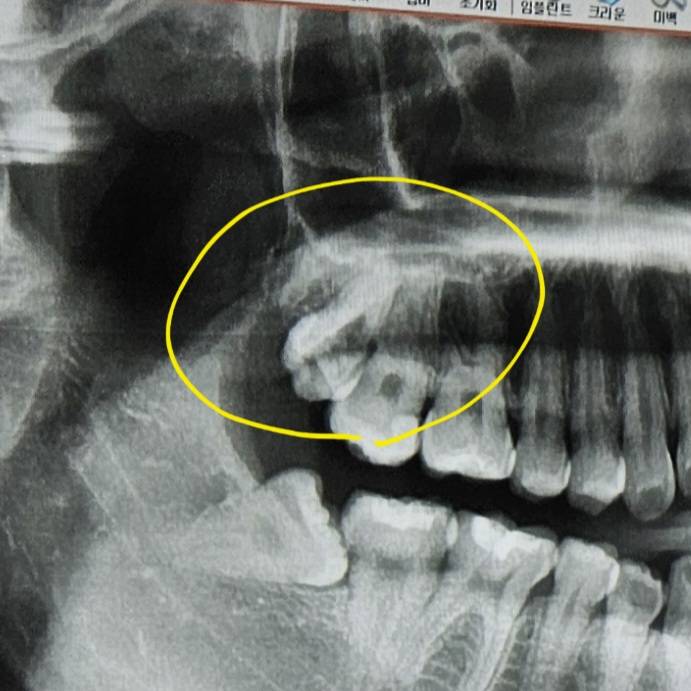 [잡담] 오늘 사랑니 발치하는 날이야 발치 쉬워보여? | 인스티즈