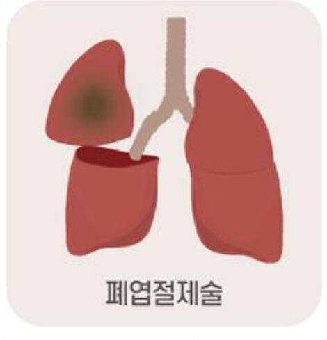 [잡담] 나 폐엽절제술이란 수술 받아본 익인인데 질문받아! | 인스티즈