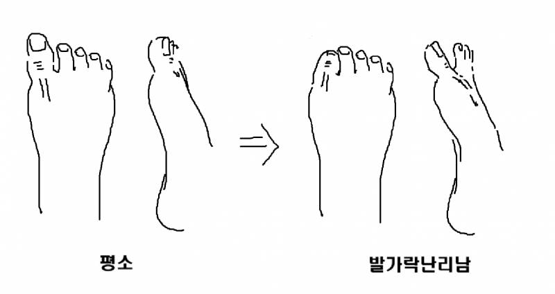 [잡담] 엄지발가락뼈가 자꾸 어긋나는데 이거 왜이래..?ㅋㅋㅋ큐ㅠㅠㅠ | 인스티즈