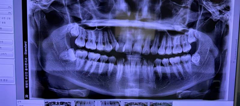 [잡담] 이거 사랑니 빼야되는걸까...?(엑스레이사진 잇음!!!) | 인스티즈