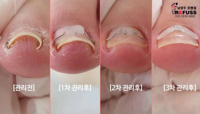 [잡담] 내성발톱 교정 치료 받았다! 질문 받음 | 인스티즈