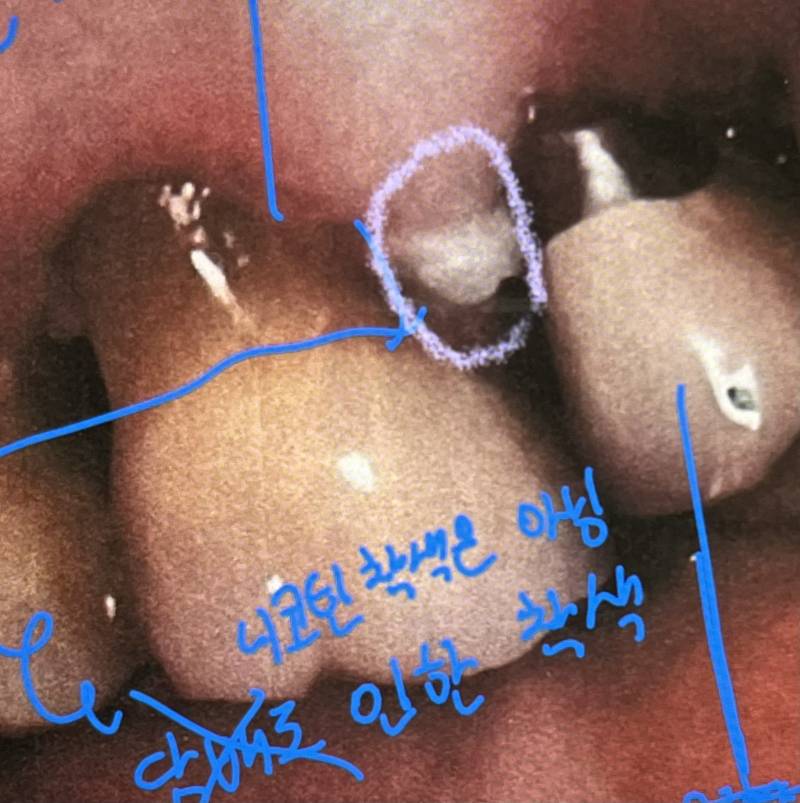 [잡담] 치과 / 치위 ❣️치아에 대해서 잘 아는 익들아❣️ ㅠㅠ! 혹시 이게 뭘까..?🥺🥺🥺 | 인스티즈