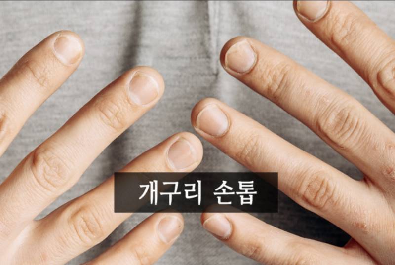 [잡담] 손톱 바디 개짧은데 어떻게 길러? | 인스티즈