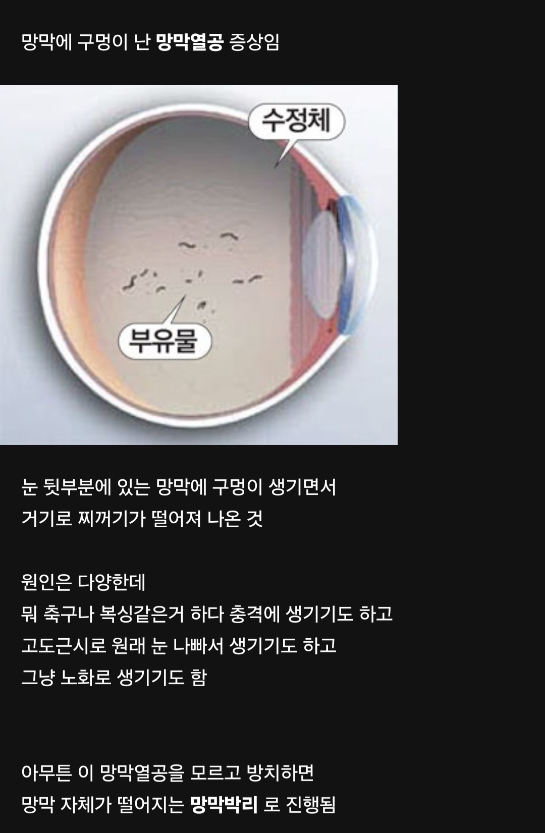 방치하면 실명까지 갈 수 있는 망막열공 자가 진단 방법.jpg | 인스티즈