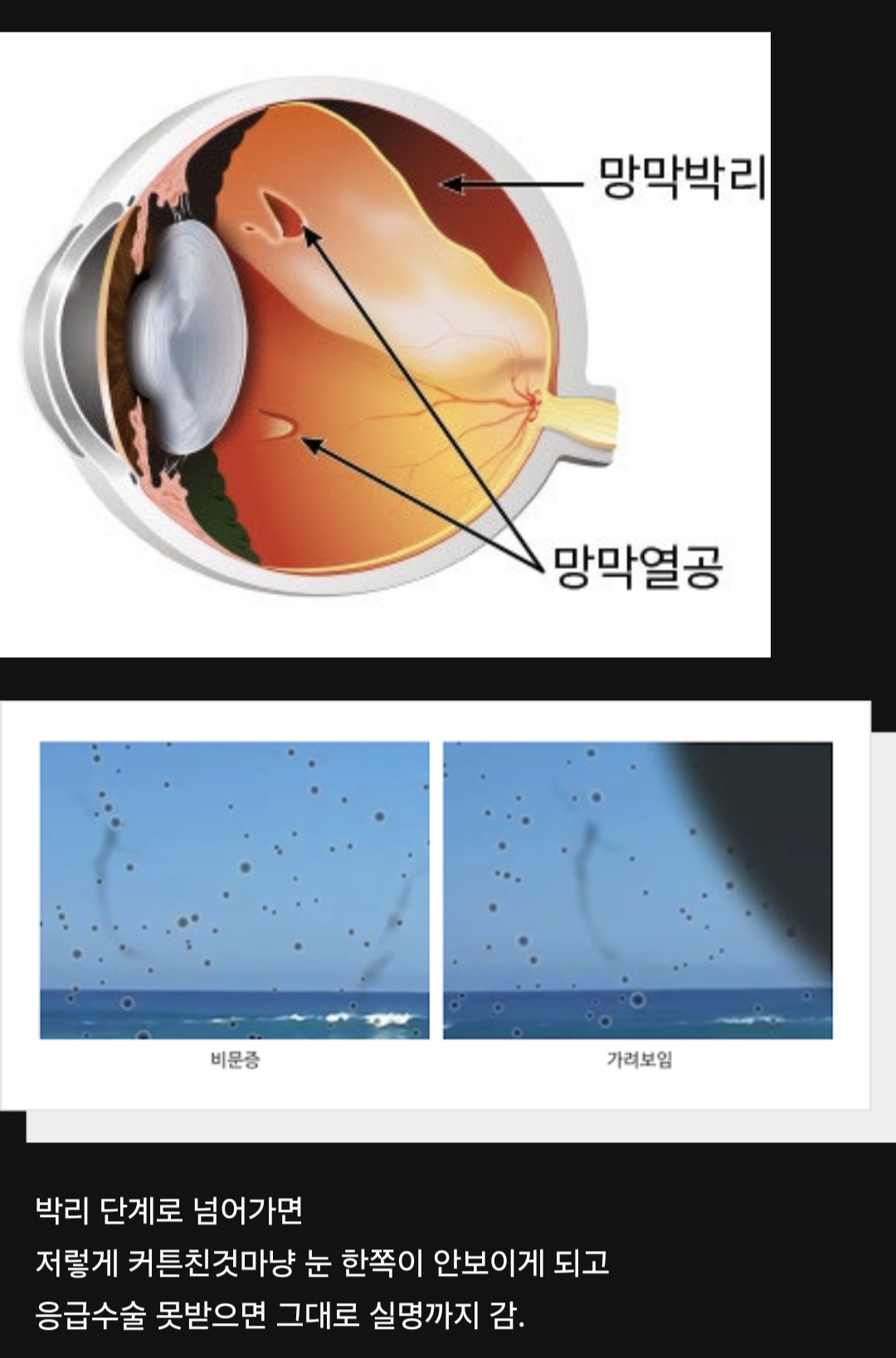 방치하면 실명까지 갈 수 있는 망막열공 자가 진단 방법.jpg | 인스티즈