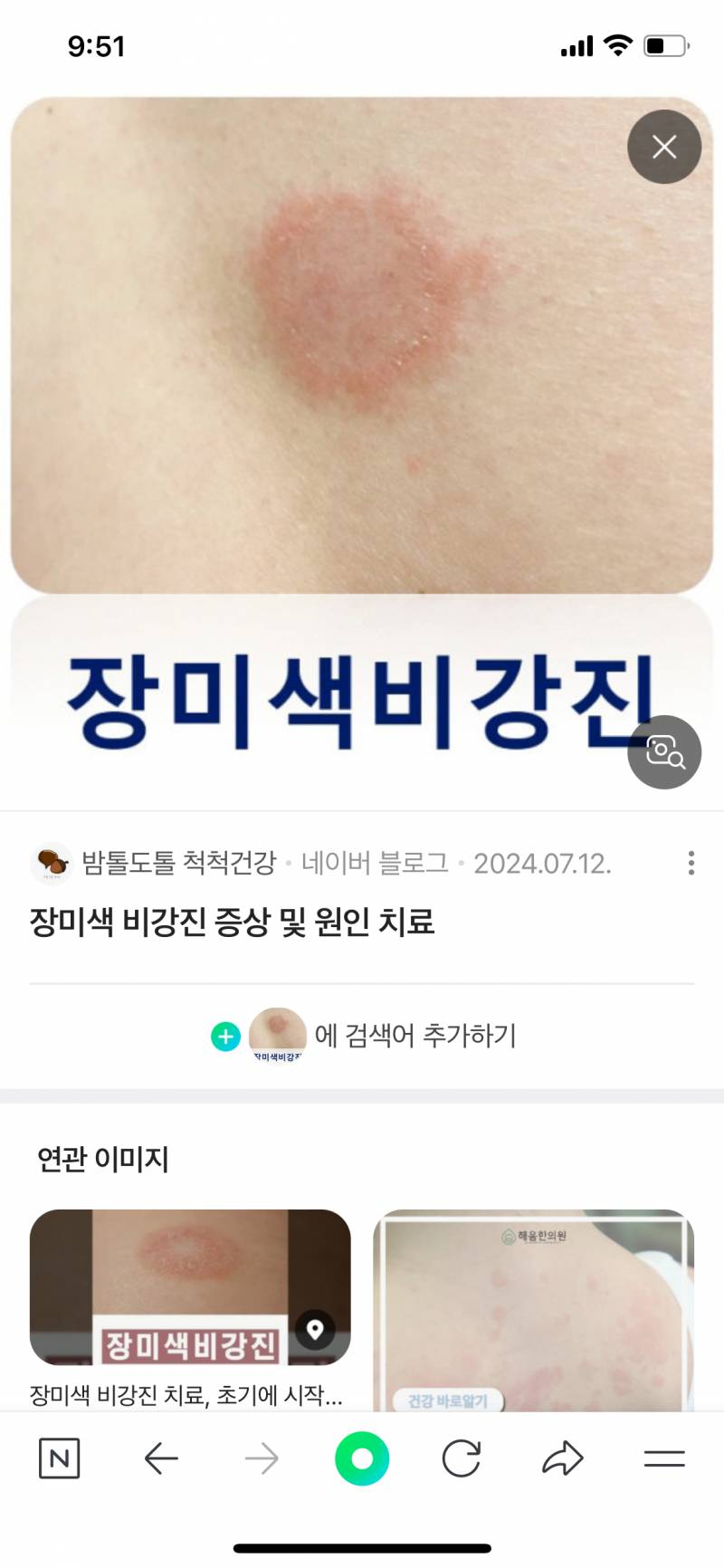 [잡담] 난 몸에 이거생긴 걸로 면역력 낮아졌는지 확인함 | 인스티즈