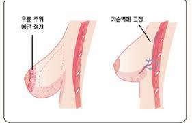 [잡담] 나 유두 주변 수술 해야하나 고민중이야..ㅜㅜ | 인스티즈