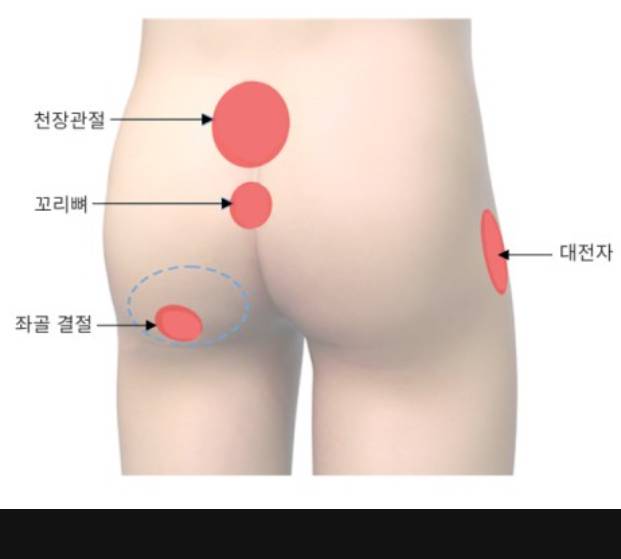 [잡담] 나 진짜 갑자기 앉을때랑 누울때 엉덩이 뼈가 닿아서 너무 아픈데 왜이러는거야..?겪어본 익들 있음? | 인스티즈