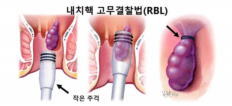 [팁/자료] 치질 고무밴드 결찰술 후기 | 인스티즈