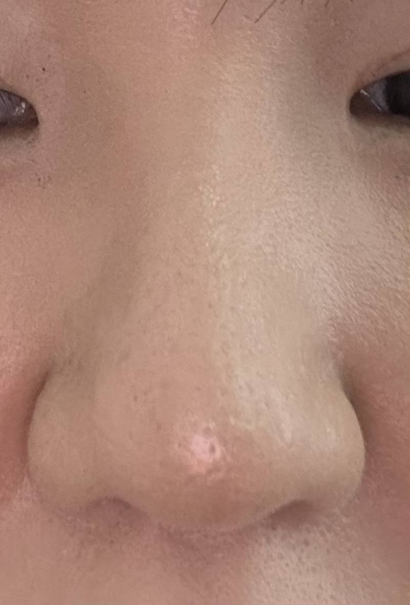 [잡담] 나 코수술한거 티 나? | 인스티즈
