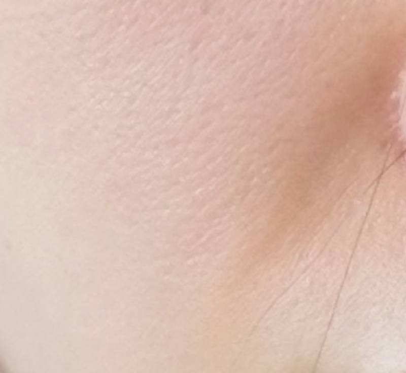 [잡담] 20대초인데 울쎄라받는거 오바야..? | 인스티즈