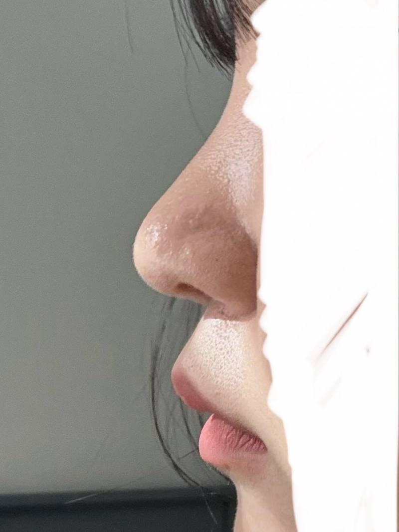 [잡담] 나 코수술한거 티 나? | 인스티즈