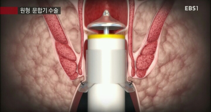 15분만에 끝나는 치핵수술.jpg | 인스티즈