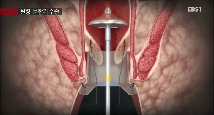 15분만에 끝나는 치핵수술.jpg | 인스티즈