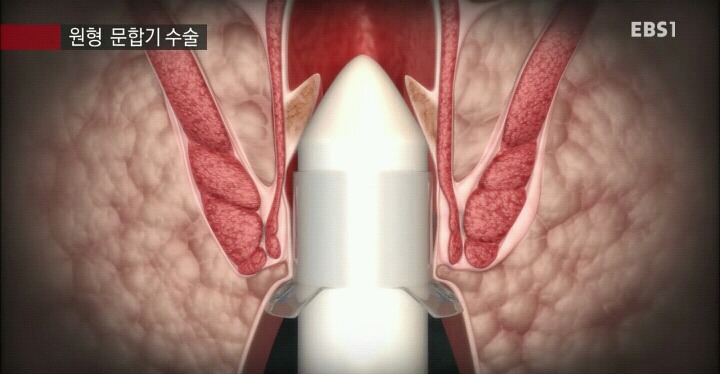 15분만에 끝나는 치핵수술.jpg | 인스티즈