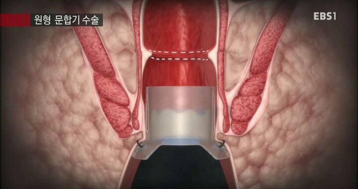 15분만에 끝나는 치핵수술.jpg | 인스티즈