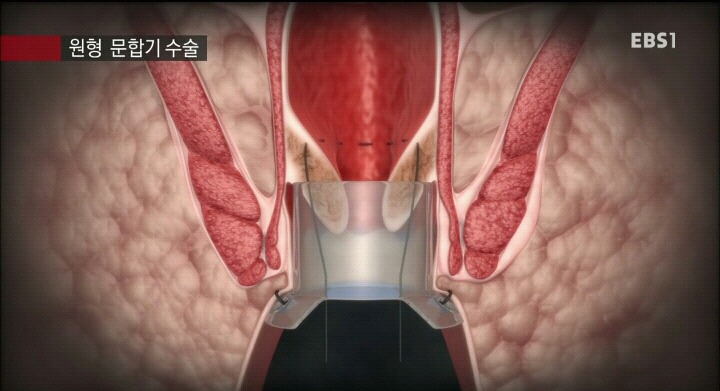 15분만에 끝나는 치핵수술.jpg | 인스티즈