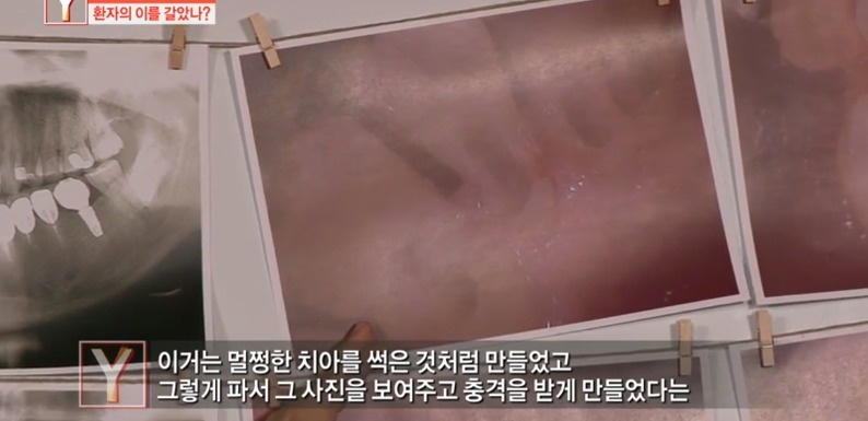 [궁금한이야기] 같은 치과 의사들도 충격받았다는 진료사진.jpg | 인스티즈