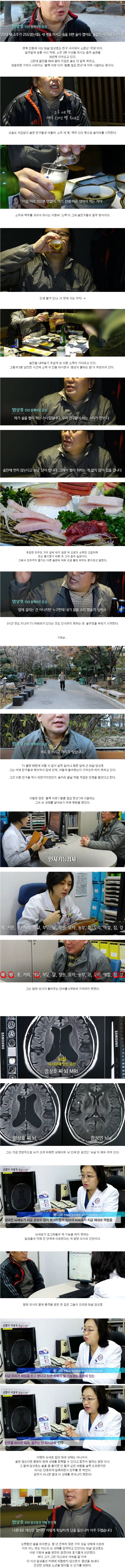 술 마시면 자주 필름이 끊기는 50살 남성의 뇌 상태.jpg | 인스티즈