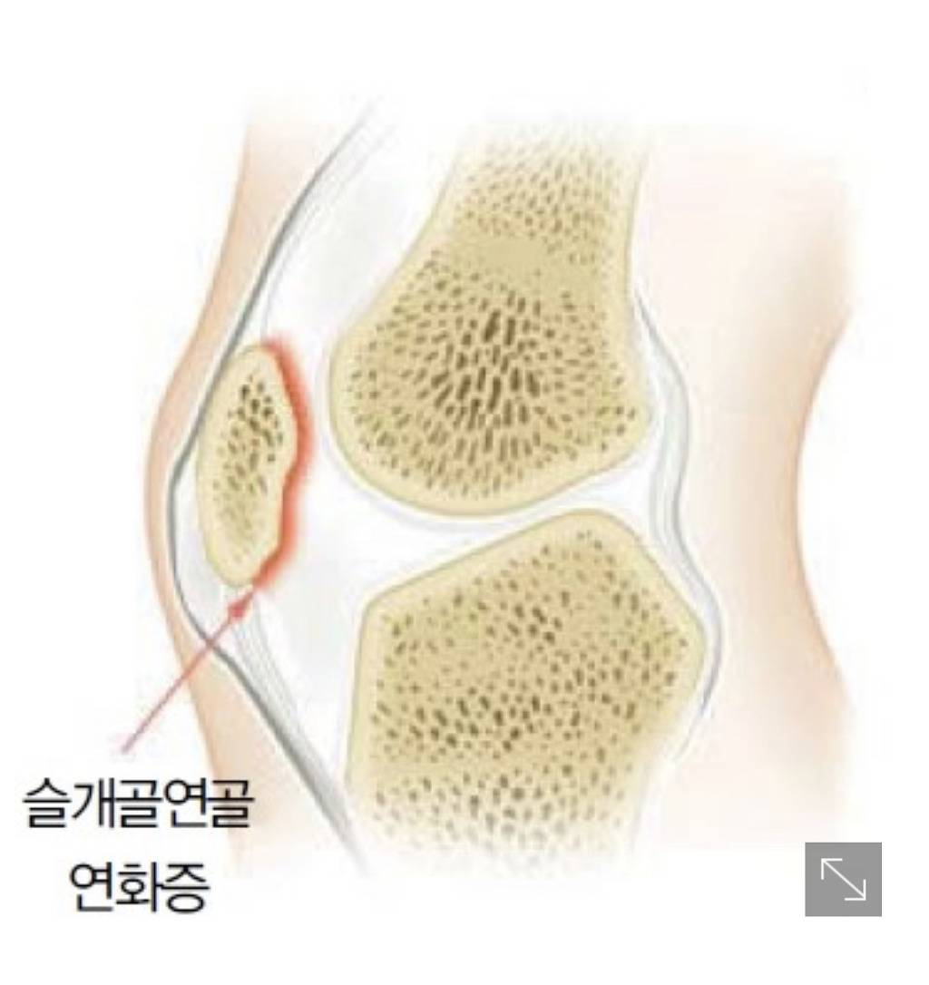 질병정보) 최악의 20대 무릎 질환 - 슬개골연골연화증 | 인스티즈