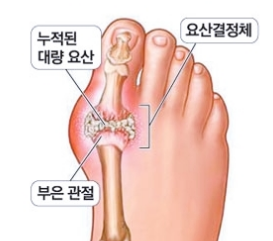 '1일1닭' ' 단백질 열풍' 폭탄 터지나 - 통풍 환자 2배로 증가 , 대안은? | 인스티즈